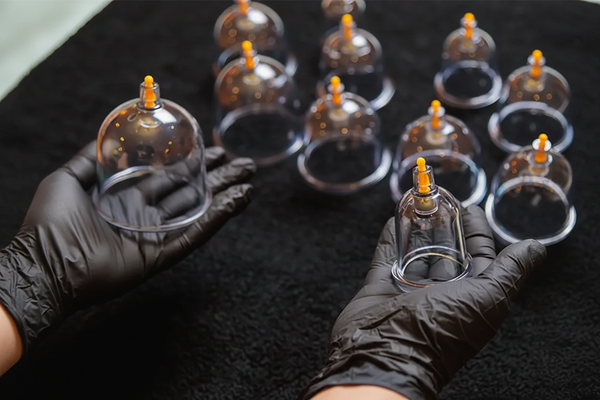 Hijama Therapy